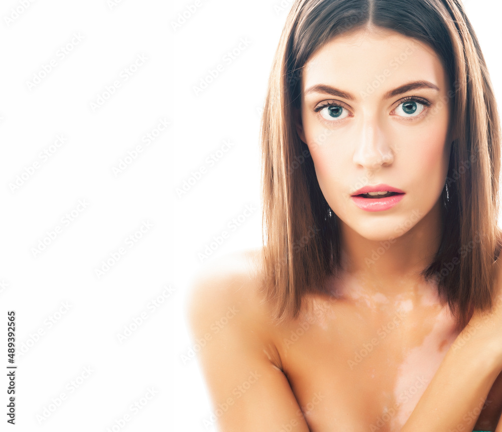 beautiful young brunette woman with vitiligo disease close up isolated on white beautiful young brunette woman with vitiligo disease close up isolated on white