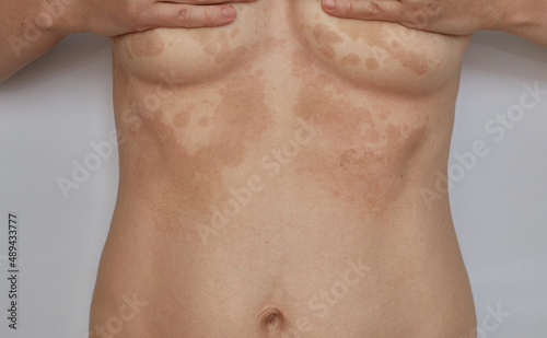 Shingles, Pityriasis on the skin. Skin diseases and dermatological problems. photo