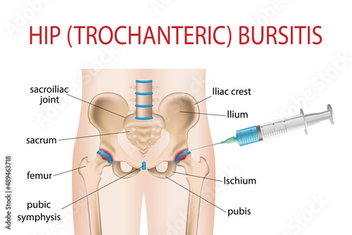 illustration of painful hip sacral inflammation, hip pain bursitis, arthritis