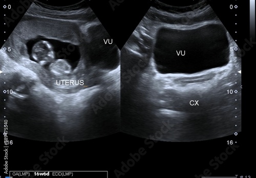 Εκτύπωση καμβά Ultrasound scan of a 16-week old fetus