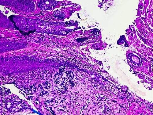 Tissue from ulcerated face lesion (biopsy) microscopic show  Basal cell carcinoma. Zoom image photo