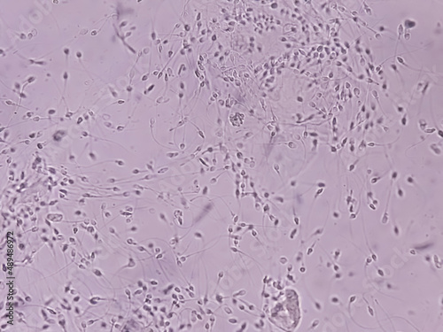 Polyzoospermia analyzed by microscope. Semen analysis normal sperm and morphology. Zoom image photo
