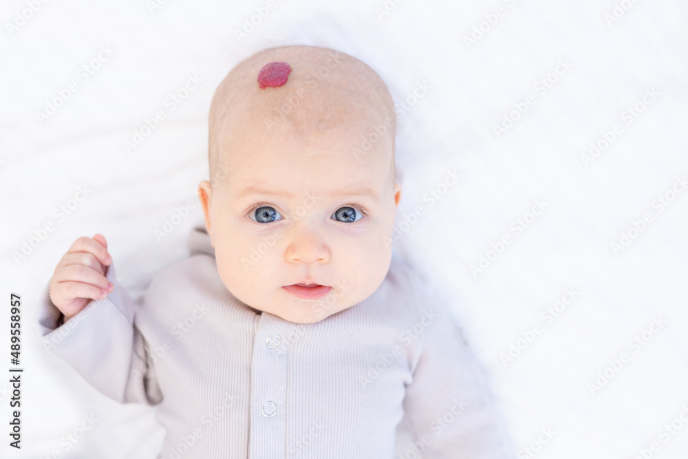 portrait of a baby with a red hemangioma or tumor on the head, child girl in a cotton suit lying at home on a white bed and smiling