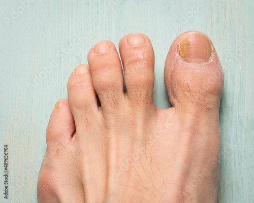 фотографія Toenails with fungus problems,Onychomycosis, also known as tinea unguium, is a fungal infection of the nail, green background