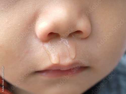 Photos Boy is cold and has runny nose