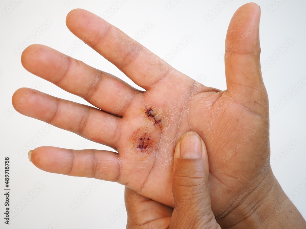 Hand surgery done to alleviate Dupuytren"s contracture or finger lock