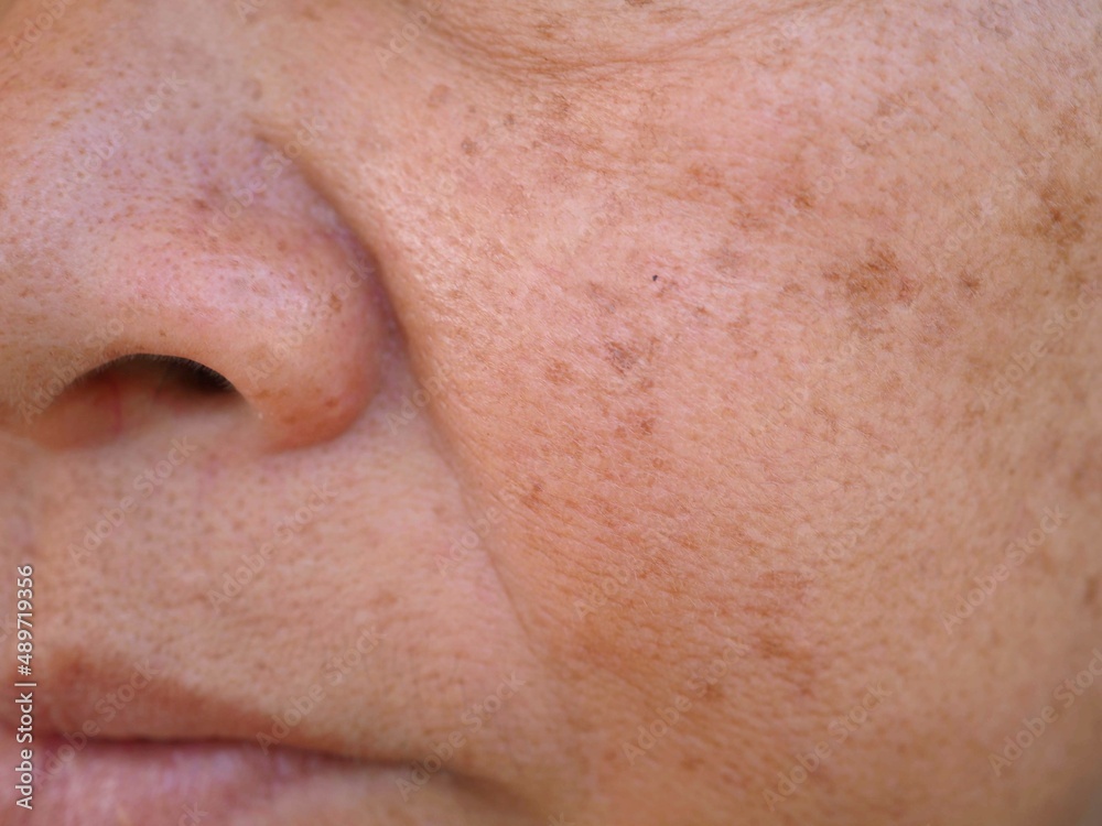 Freckles on the face. closeup photo, blurred. Freckles on the face. closeup photo, blurred.