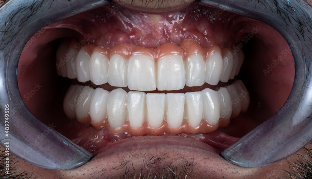 Obraz premium press ceramic crowns on implant bridges