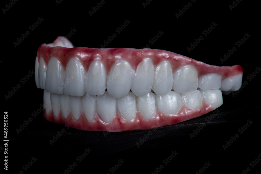 press ceramic crowns on implant bridges press ceramic crowns on implant bridges