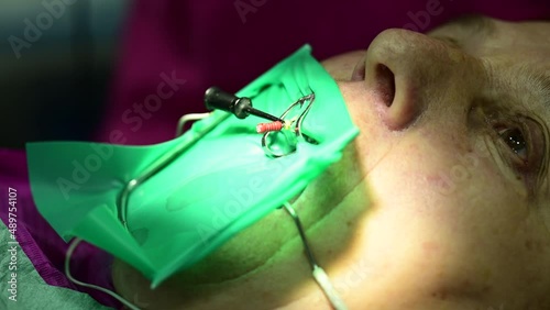 The dentist uses a root needle to treat the tooth, the dental needle in action.