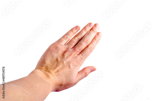 skin irritation on left wrist dermatitis
