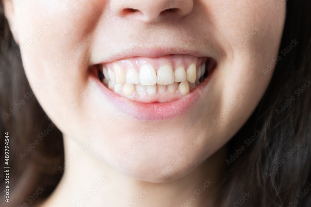 Dentistry. Demonstration of woman's beautiful smile. The concept of teeth whitening and alignment Dentistry. Demonstration of woman's beautiful smile. The concept of teeth whitening and alignment
