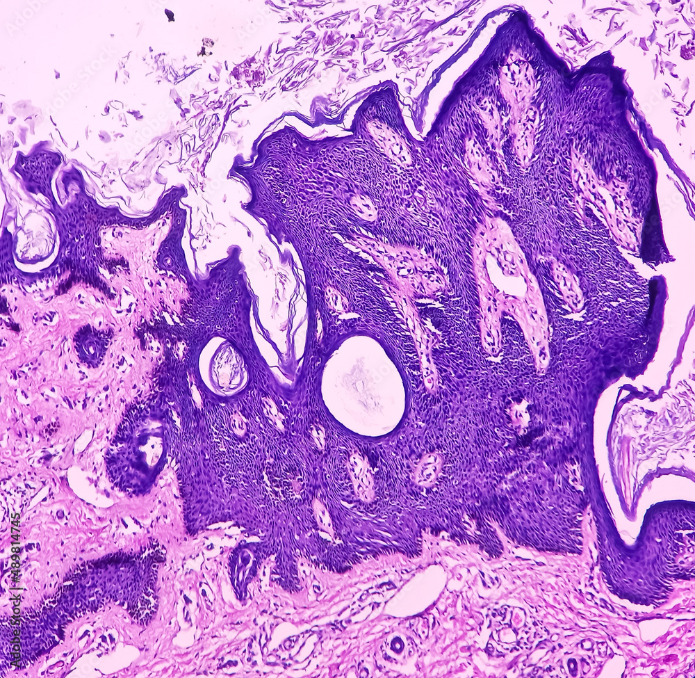 Stockfoto med beskrivningen Skin(biopsy) Seborrhoeic keratosis, epidermis show hyperkeratosis