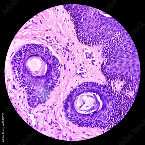 Tablou pe pânză Skin(biopsy): Seborrhoeic keratosis, epidermis show hyperkeratosis, acanthosis, pseudo horn cysts, focal area of squamous eddies