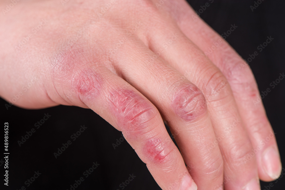 close up of female hand with chilblain on black background close up of female hand with chilblain on black background