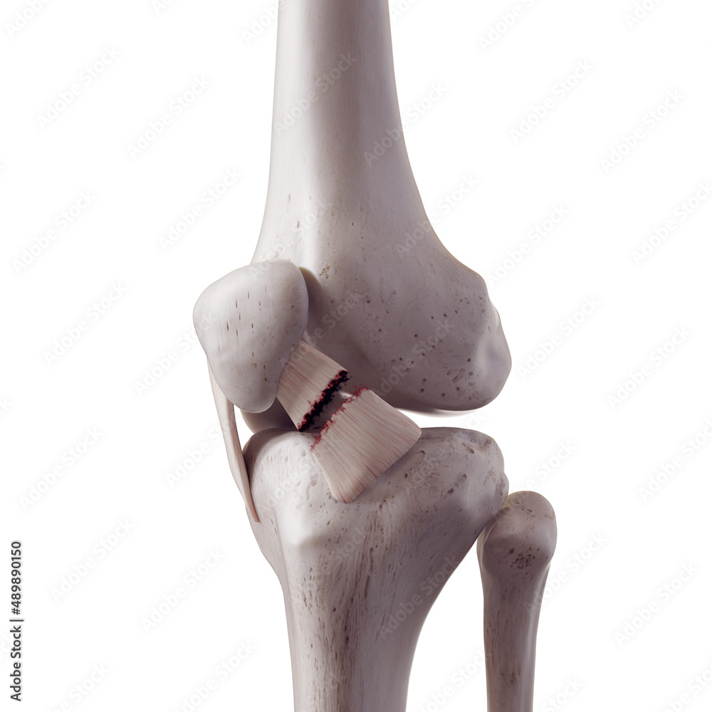 Ταπετσαρία 3d rendered medically accurate illustration of a torn lateral patellar ligament