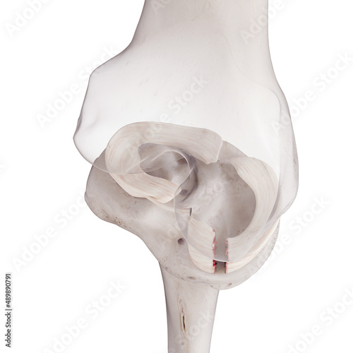 Photography 3d rendered medically accurate illustration of a torn medial miniscus