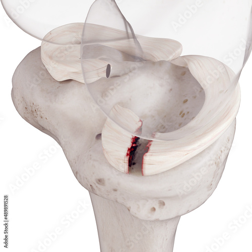 Fotografía 3d rendered medically accurate illustration of a torn medial miniscus