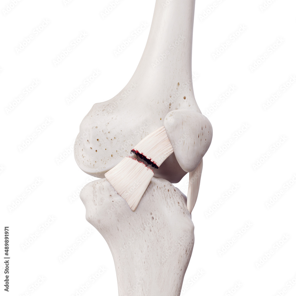 3d Rendered Medically Accurate Illustration Of A Torn Medial Patellar Ligament Stock 3045