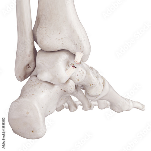 3d rendered medically accurate illustration of a torn posterior tibiotalar ligament photo