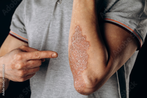 Acute psoriasis on the elbows is an autoimmune incurable dermatological skin disease. A large red, inflamed, flaky rash on the elbows. Joints affected by psoriatic arthritis