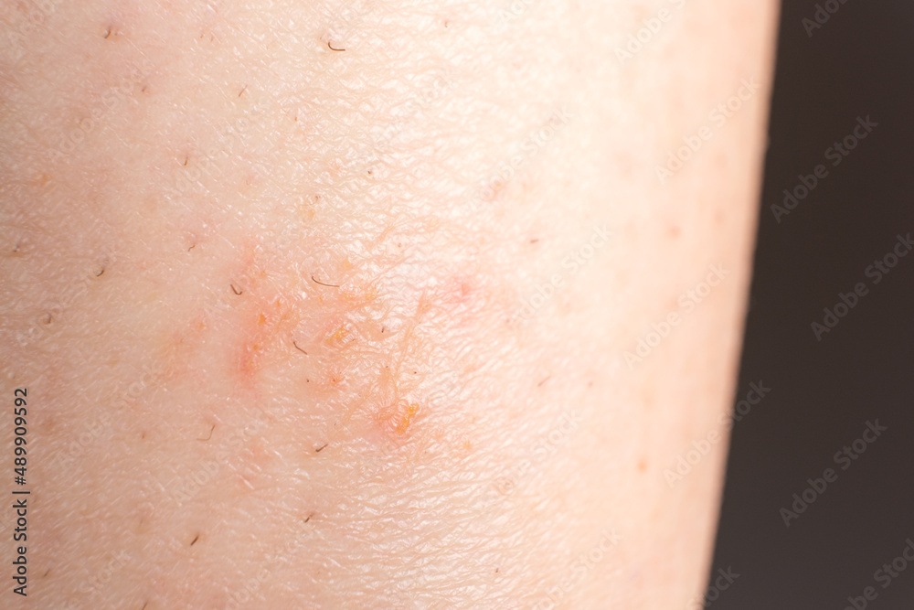 Streptoderma - dermatitis on human skin, red round spot, macro photography, bacterial inflammation Streptoderma - dermatitis on human skin, red round spot, macro photography, bacterial inflammation