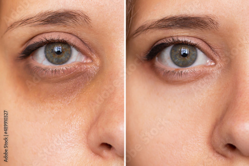 Cropped shot of a young caucasian woman's face with dark circles under eyes before and after cosmetic treatment. Bruises under the eyes caused by fatigue, insomnia, stress. The result of therapy