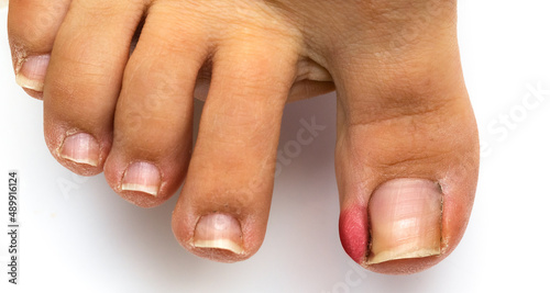 Female foot with swollen and red toe due to an ingrown toenail photo