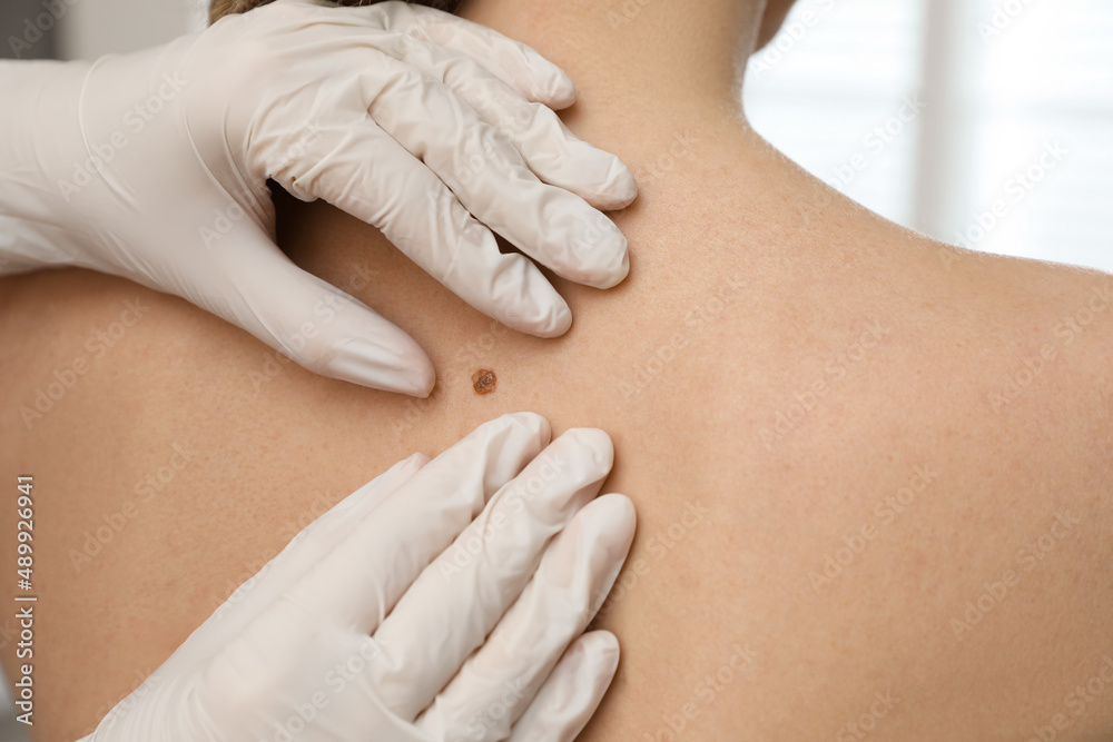 Naklejka premium Dermatologist examining patient's birthmark in clinic, closeup view