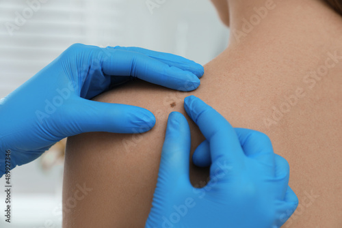 Dermatologist examining patient s birthmark in clinic  closeup view