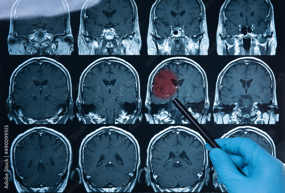 Doctors reviewing brain xrays;MRI of the blood vessels in the brain