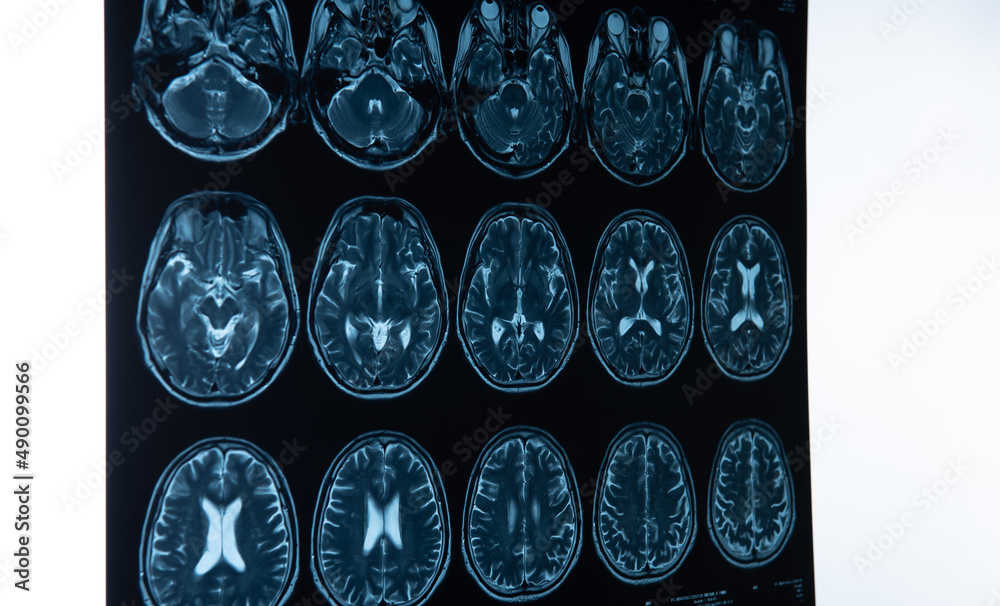 Brain stroke x-ray;MRI of the blood vessels in the brain and ...