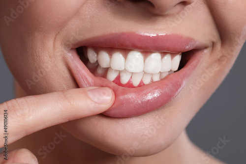 Young woman showing inflamed gums on grey background, closeup