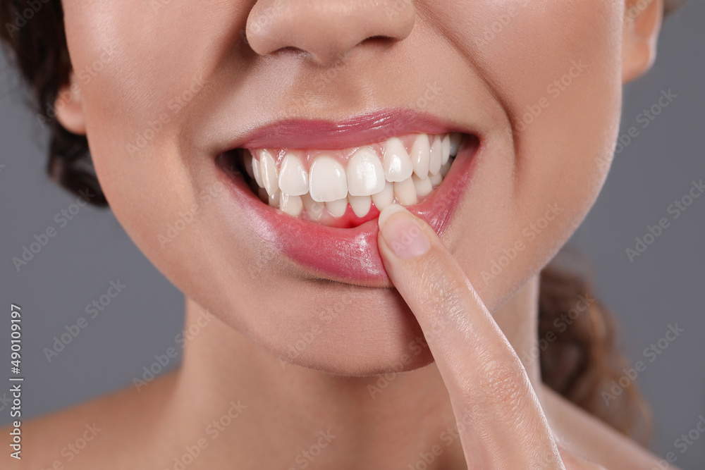 Young woman showing inflamed gums on grey background, closeup Young woman showing inflamed gums on grey background, closeup