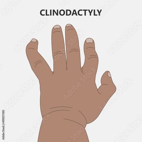 Hand finger gene prader willi band autism surgery baby simple thumb Apert minor born toes feet fused club hand Cleft Birth Ulnar multiple leg clubfoot child claw aplasia wrist forearm deformity extra