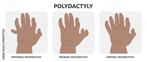 Hand finger gene prader willi band autism surgery baby simple thumb Apert minor born toes feet fused club hand Cleft Birth Ulnar multiple leg clubfoot child claw aplasia wrist forearm deformity extra