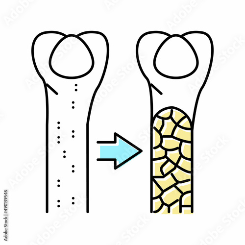 osteoporosis bone disease color icon vector illustration