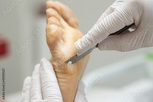 Orthopedist scalpel cuts off dry callus on the foot and on the toes