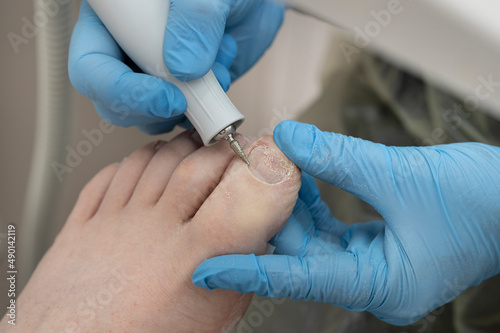 Pedicure podology treatment process of onychomycosis fungal infection of the toenail. filing of the nail plate for the treatment of nail fungus.