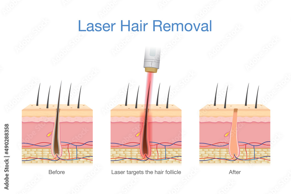 Laser hair removal at the skin layer and follicle for beauty and smoothness. Medical diagram