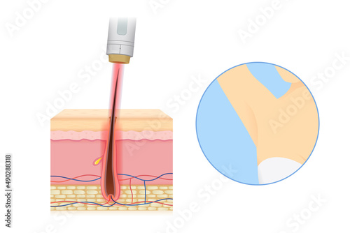Laser hair removal at the skin layer with armpit of woman. Illustration about hair removal for beauty and smoothness.