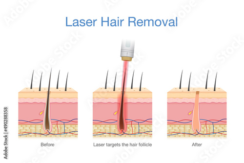 Laser hair removal at the skin layer and follicle for beauty and smoothness. Medical diagram before and after use laser get rid hair.