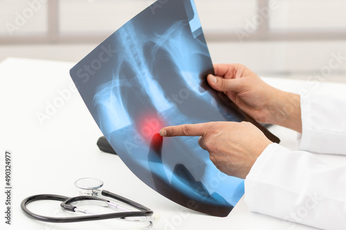 Male doctor looking at x-ray radiograph and pointing to the injury caused by lung disease, long COVID-19 in the hospital