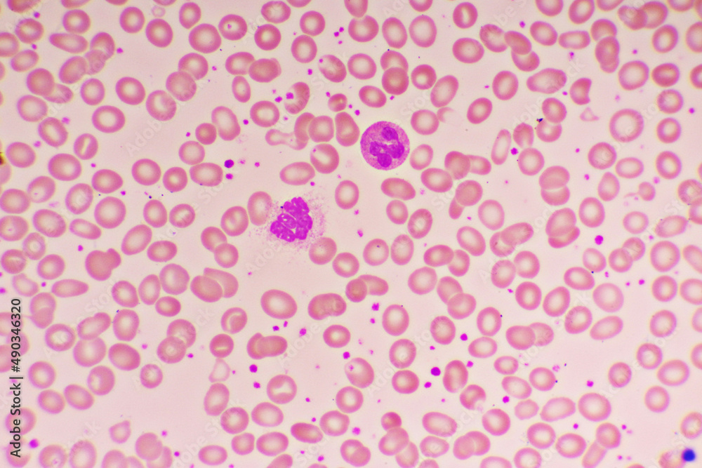 Essential thrombocytosis blood smear, present abnormal high platelet and neutrophil cell, analyze by microscope