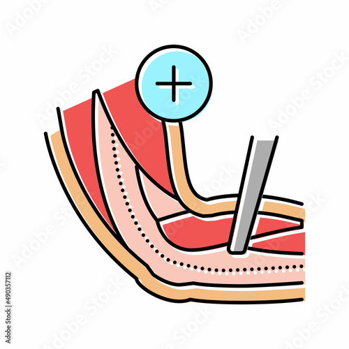 ulnar nerve release color icon vector illustration