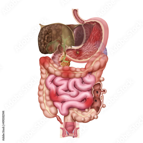 소화기계 질환 메디컬일러스트 photo