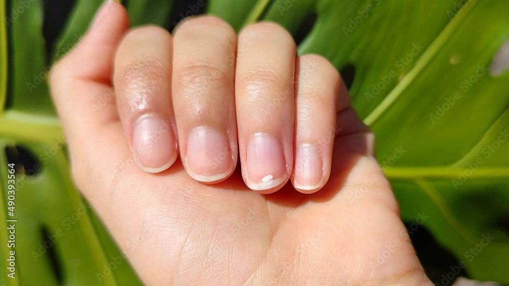 Leukonychia: What are those white marks on your nails?