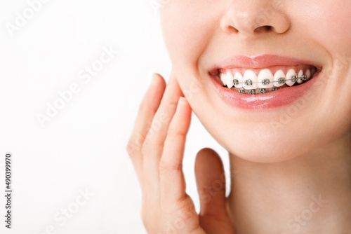 Smile with Braces Orthodontic Treatment. Dental Care Concept. Beautiful Woman Healthy Smile close up. Closeup Ceramic and Metal Brackets on Teeth. Beautiful Female