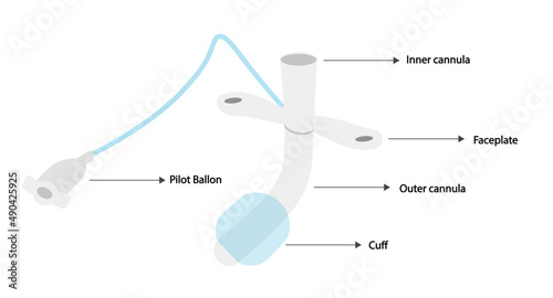Tracheostomy device anatomy. Tracheostomy insuflated cuff.  