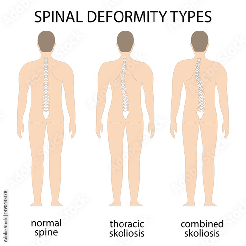 Vector illustration of spinal deformity. Kyphosis, lordosis, and scoliosis spine infographic. body posture defect. Medical, educational and scientific banner